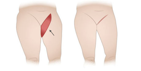 Показания к проведению и особенности операции подтяжки бедер