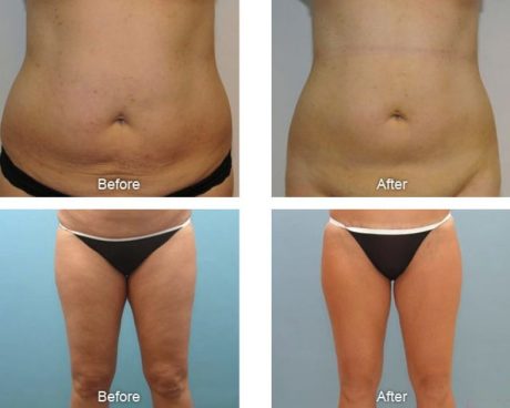 Лазерная липосакция: до и после