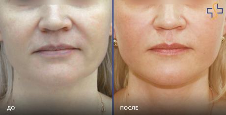 Эффект от проведения процедуры нитевого лифтинга Эффект от проведения процедуры нитевого лифтинга