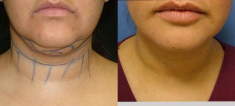 Пластика двойного подбородка