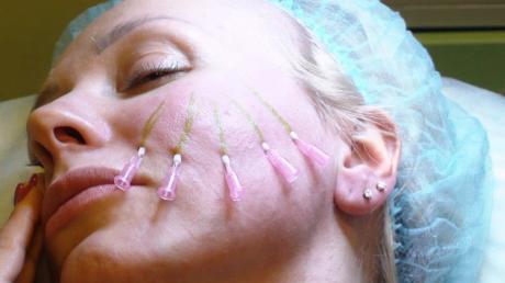 Техника исполнения нитевого лифтинга