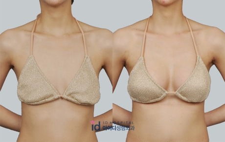 Пластика по подтяжке грудей - результат