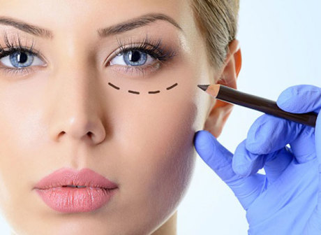 Блефаропластика