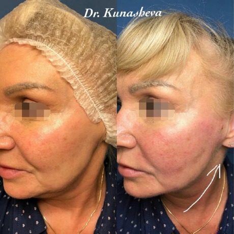 Эффект от проведения процедуры нитевого лифтинга