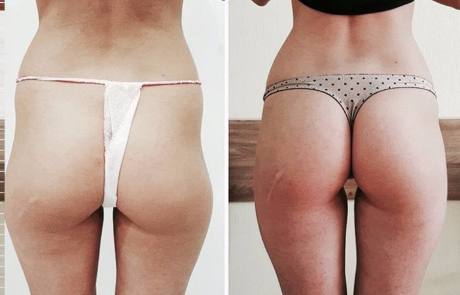 липофилинг ягодиц: до и после