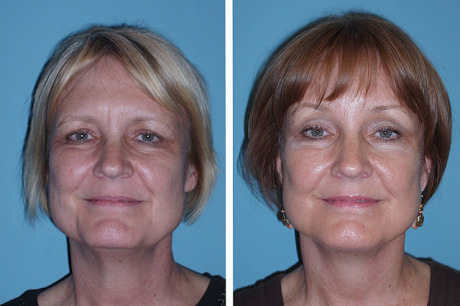 Фейслифтинг эндоскопический: до и после