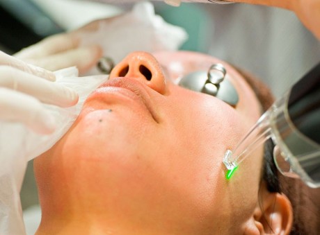 Лазерная шлифовка