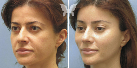 Липофилинг скул