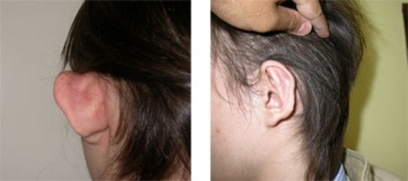 Отопластика: до и после