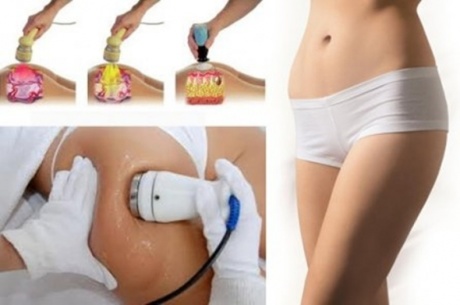 Безоперационная липосакция