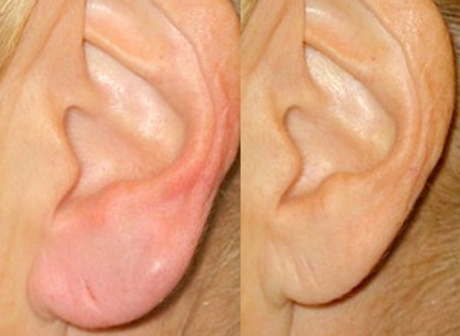 Пластика для мочек ушных раковин