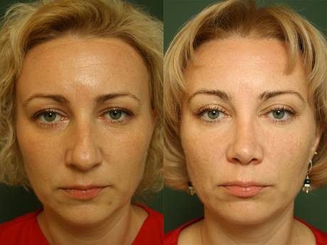 Результат подтяжки бровей и лба Результат подтяжки бровей и лба