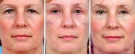 Эндотины: до и после