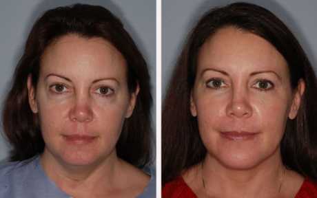 Инфракрасный лифтинг: до и после