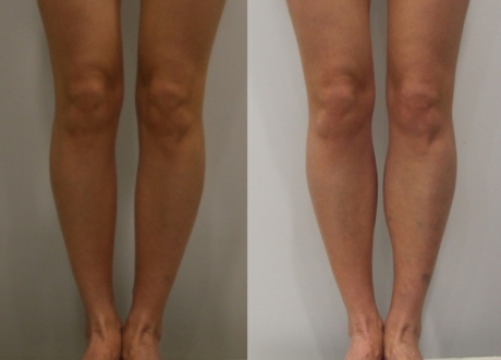 Пластика для коррекции голеней - до и после