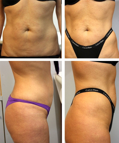 Акваликс: до и после