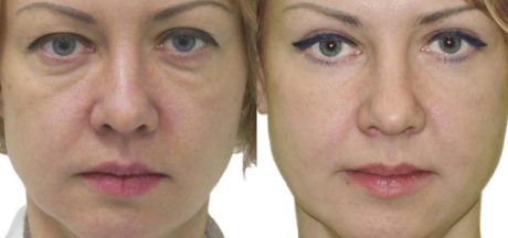 Блефаропластика