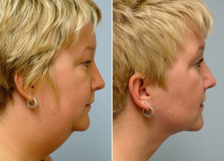 коррекция подбородка до и после коррекция подбородка до и после