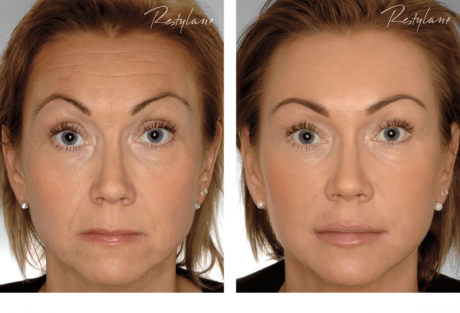 Результат проведения мезолифтинга