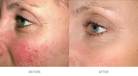 Лазерное лечение купероза Лазерное лечение купероза