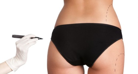 Липофилинг