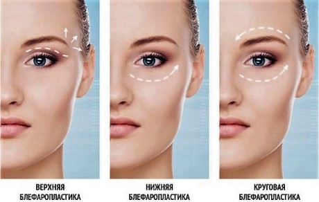 Блефаропластика: виды коррекции