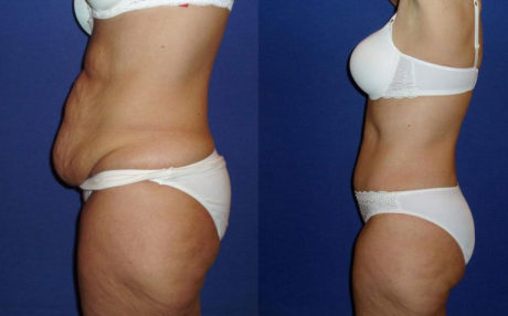 Абдоминопластика: до и после