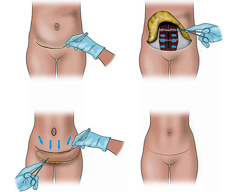 Абдоминопластика: проведение операции