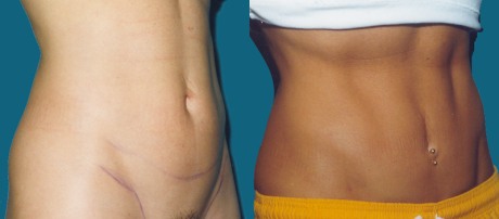 Миниабдоминопластика