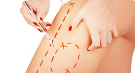 Хирургическая подтяжка кожного покрова на бедрах