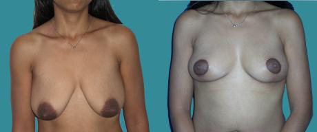 Подтяжка груди (мастопексия)