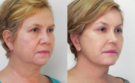 Методика SMAS лифтинга - результат