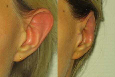 Пластика ушных раковин - до и после