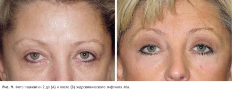 Лифтинг бровей и лба: до и после