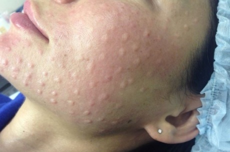 Отечность после введения филлеров ГК