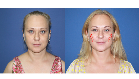 Мезонити 3Д: до и после