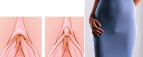 Пластика клитора