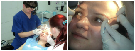 Особенности проведения трансплантации бровей