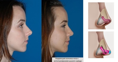 Область кончика носа - ринопластика