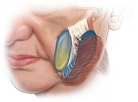 Спейслифтинг