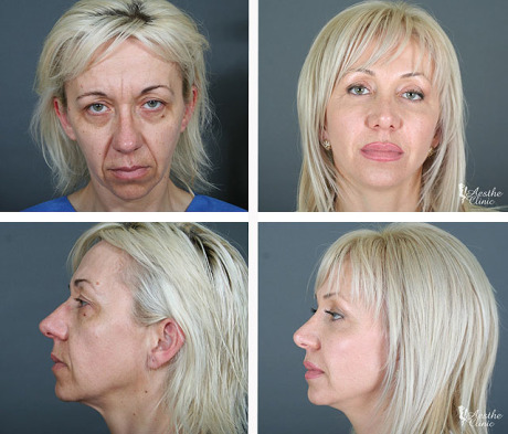 Спейслифтинг: до и после