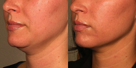 Альтера Систем - лифтинг без операции