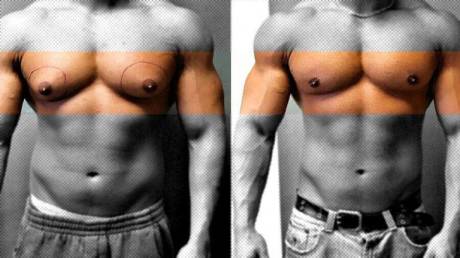 Гинекомастия у мужчин