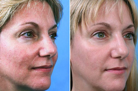 Лазерный пилинг: до и после