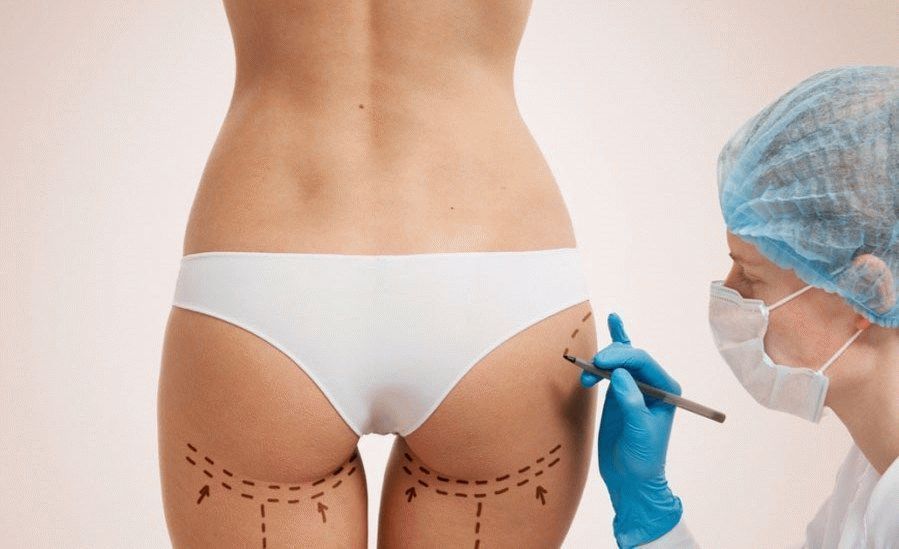 Процедура липофилинга для коррекции ягодиц