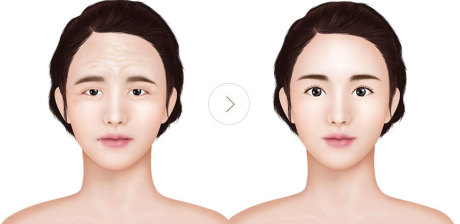 Лифтинг бровей и лба