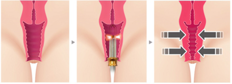 Пластика влагалища