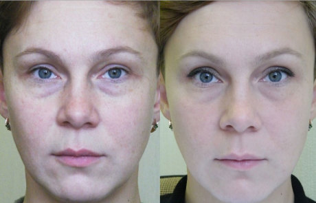 Лазерная шлифовка: до и после