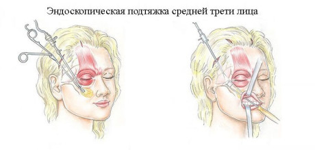Эндоскопический лифтинг - особенности