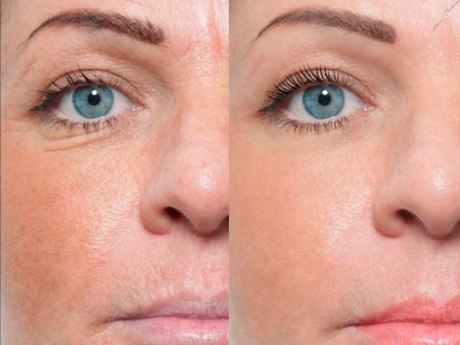 Программы комплексного гомеопатического омоложения от Bellefontaine